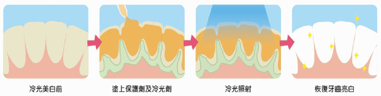 何謂冷光美白 - 晶亮牙醫